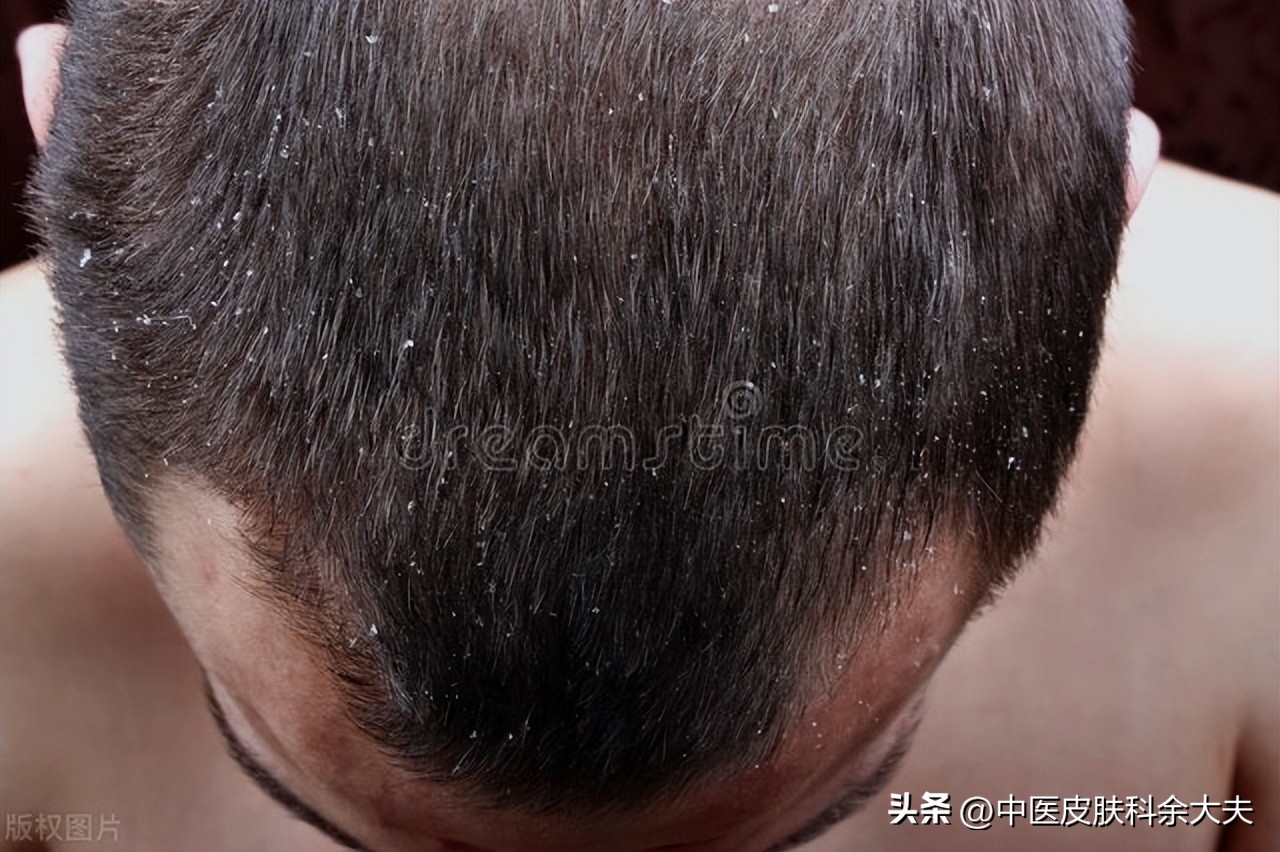 脱发严重时不妨试试以下三招,脱发是不是世界难题