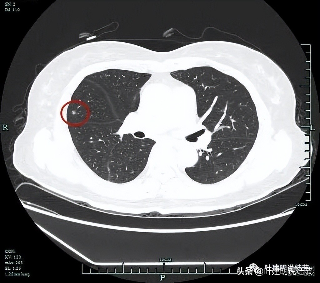 肺癌右中上叶全切,右肺上叶小结节查出是癌怎么办