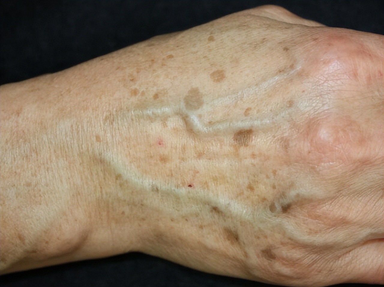 六种病属于老年病无需过度治疗,7种病不能彻底治愈