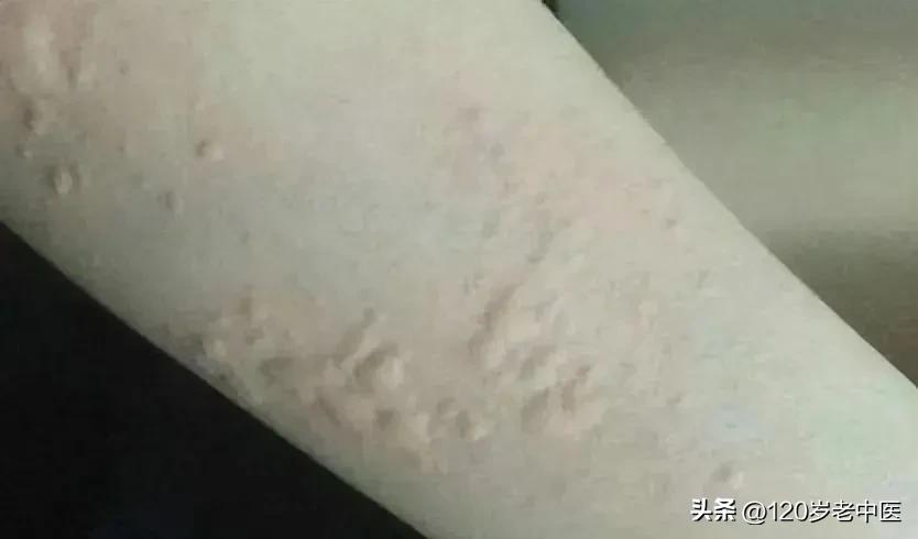 新冠感染后大便干燥可以考虑便宜又好用的防风通圣丸