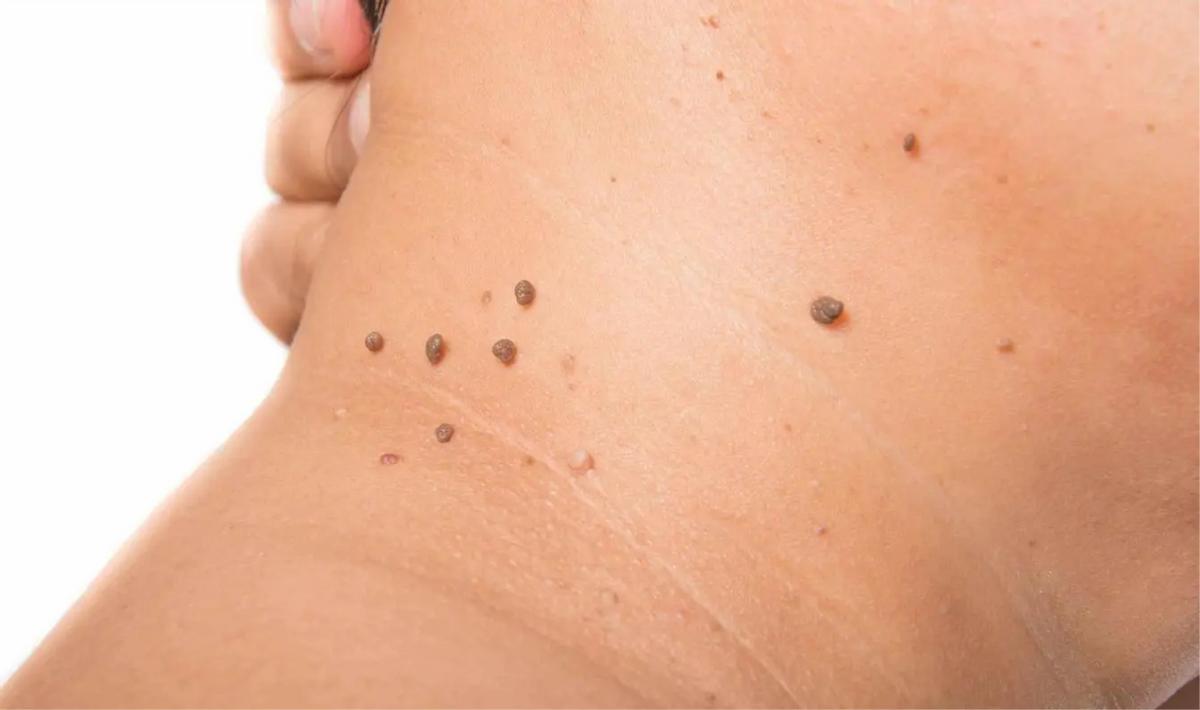 脖子上长很多丝状小肉球怎么办？医生：教你根除丝状疣和皮赘方法