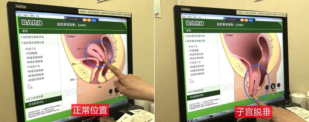 【科普】孕妈子宫“掉”到阴道口!备孕二胎,这件事一定要做