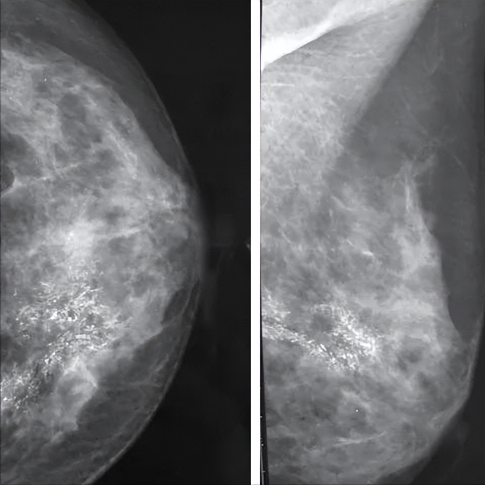 bi-rads分级4级,birads4级是癌么