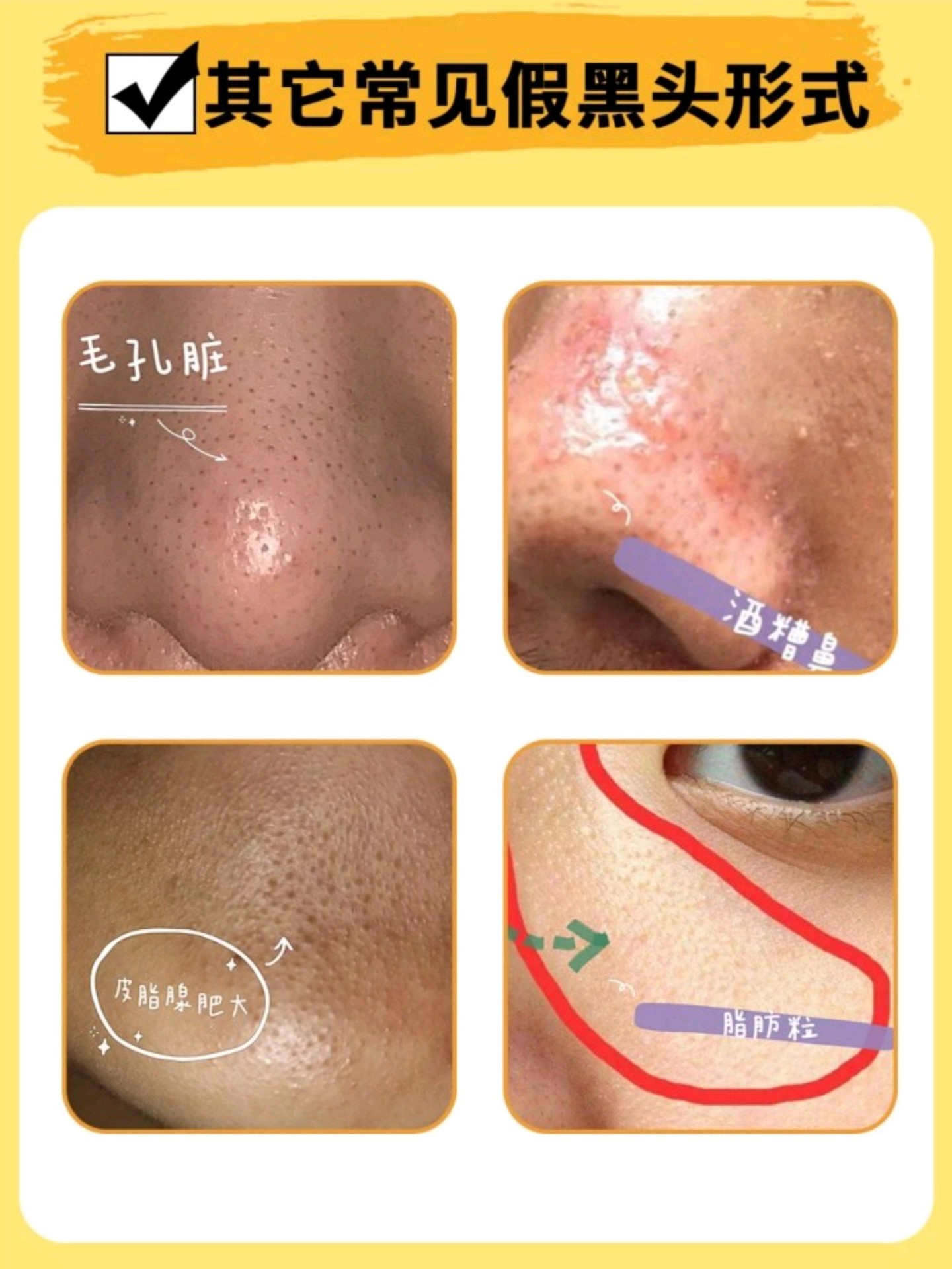 怎么去黑头好用又有效,黑头比较严重祛黑头最有效的方法