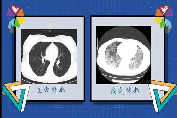 新冠对基础疾病有什么影响,现在得了新冠对身体有危害吗