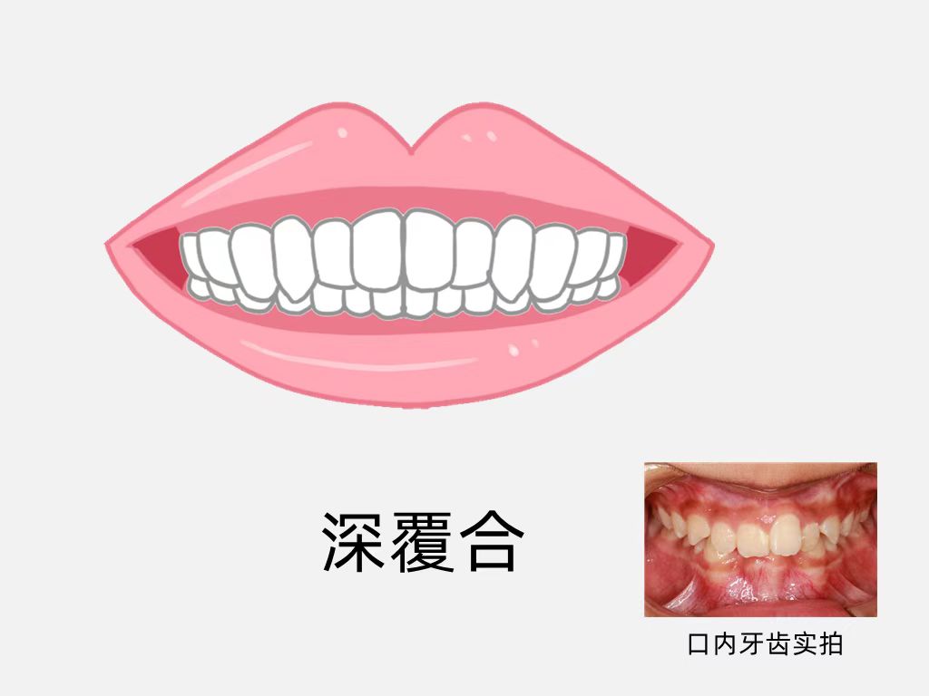 深覆合正畸适合戴隐适美吗,深覆合矫正能戴隐形牙套吗