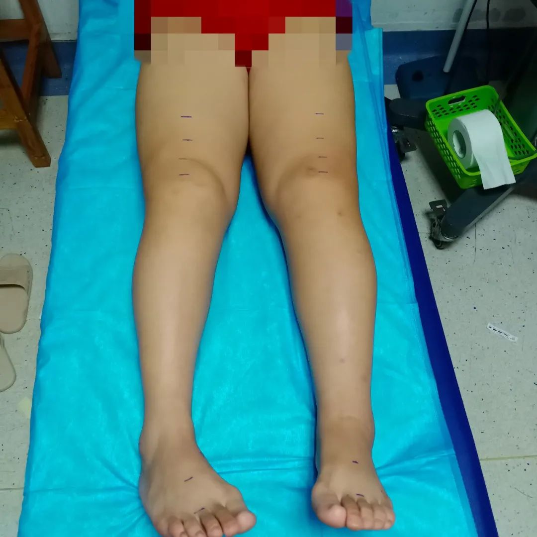 宫颈癌化疗后腿肿怎么样消肿,做了宫颈癌手术腿肿是什么原因