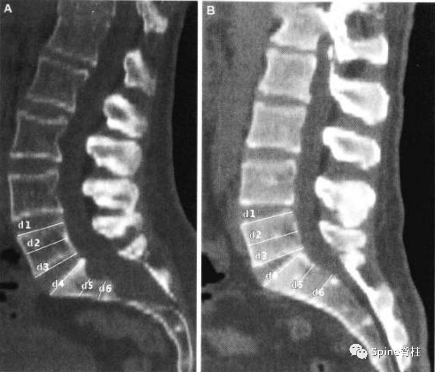 硬膜囊扩张是什么意思,硬膜囊扩张压迫神经