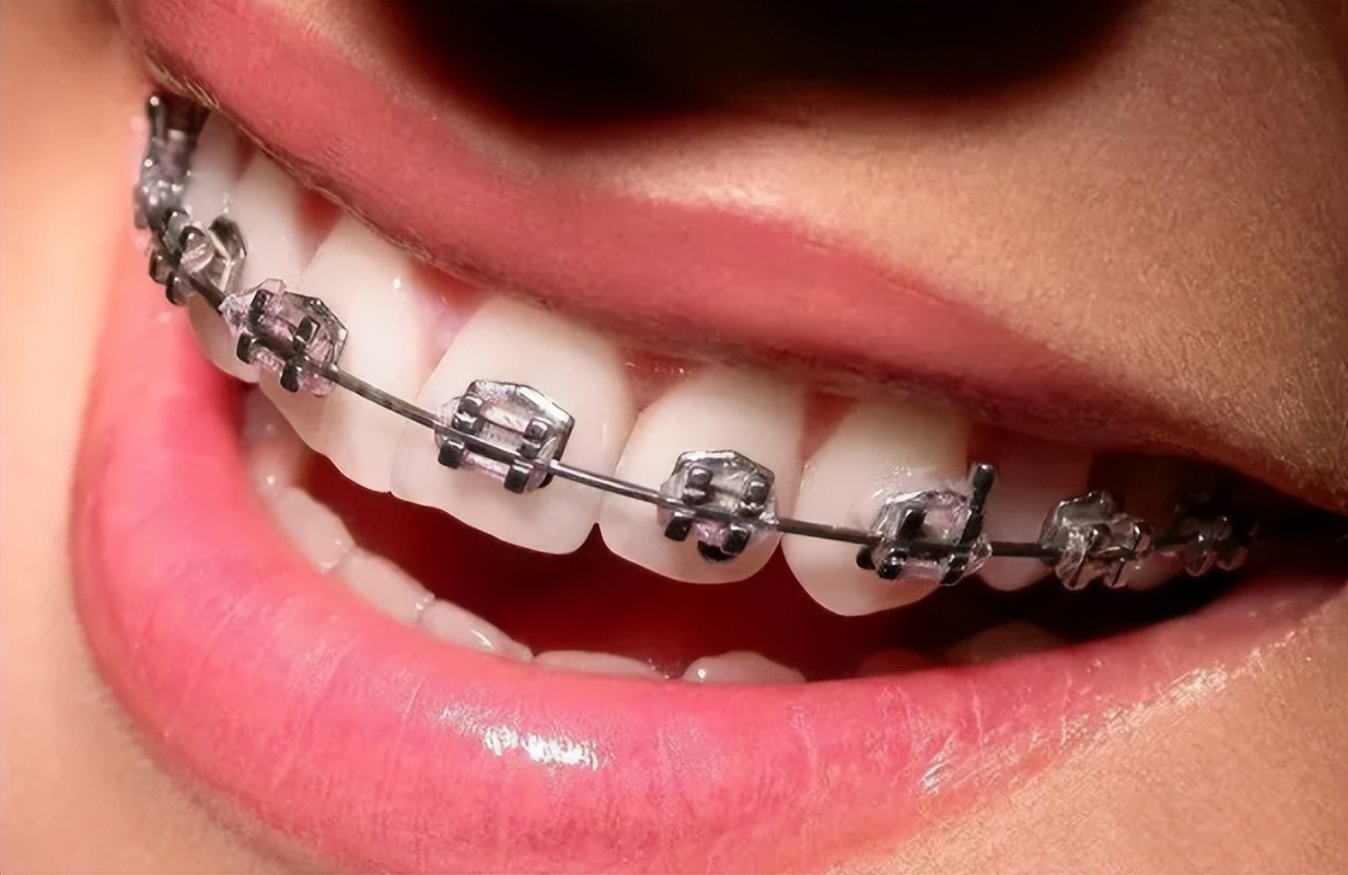 矫正牙齿想戴透明牙套,成人隐形牙套矫正牙齿大概多少钱