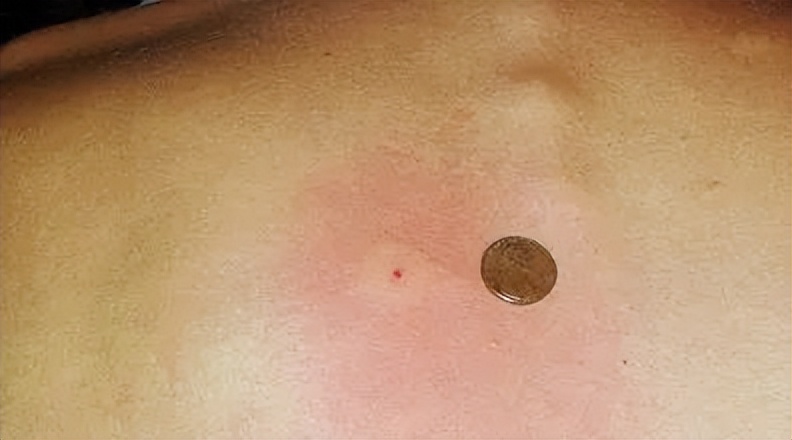 夏日带孩子户外活动当心这种虫,暑期带娃小心毒虫