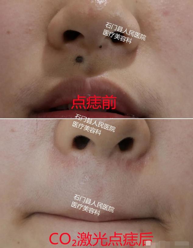 哪些痣应该点哪些痣不应该点,痣多适合什么点痣方法