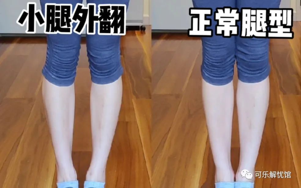小腿外翻小腿粗壮不直怎么办,小腿外翻直腿教程