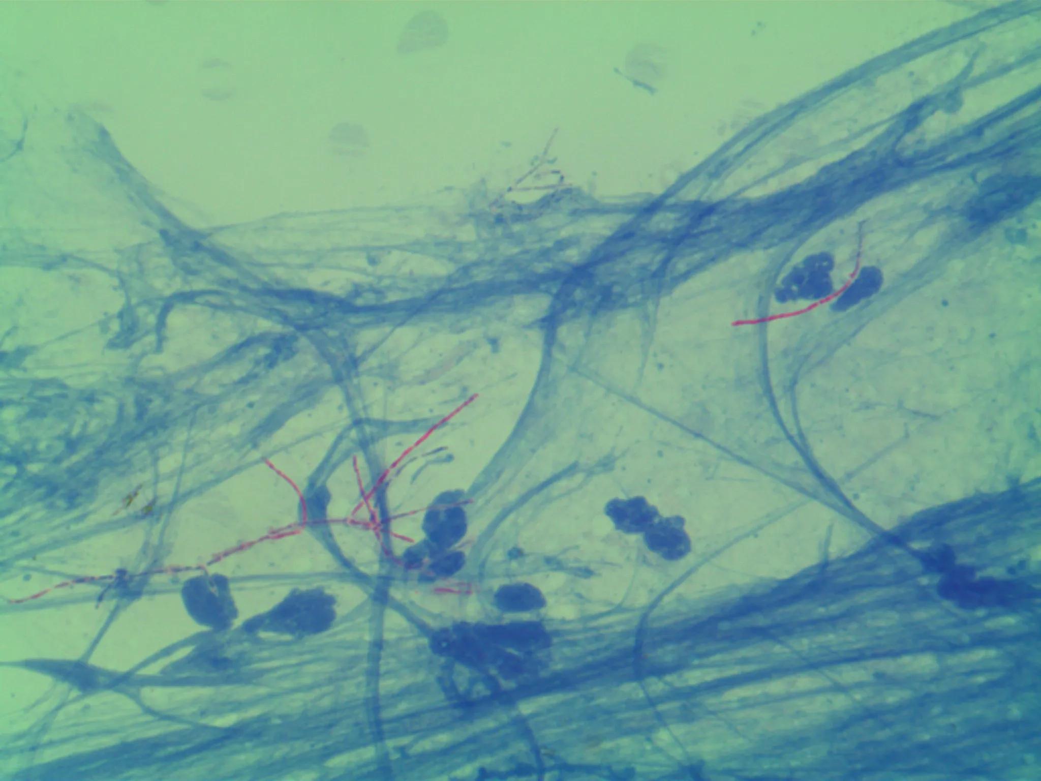 奴卡菌和结核菌,奴卡菌属于非结核分枝杆菌吗