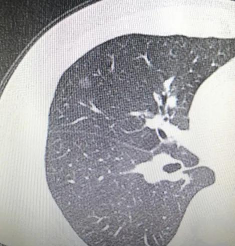 磨玻璃结节肺癌？不用担心，我来保护你未来的好日子