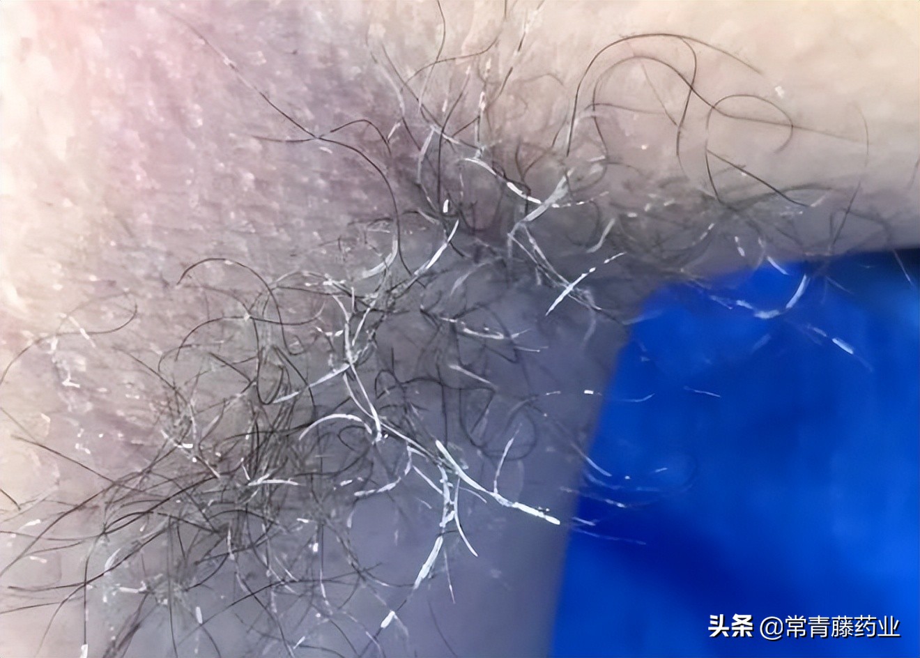 腋毛癣是狐臭的原因吗,腋毛癣和狐臭的区别有哪些呢