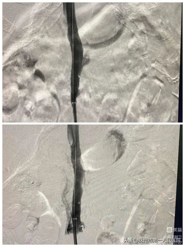 布加氏综合征介入治疗的注意事项,布加综合征介入手术加支架的利弊