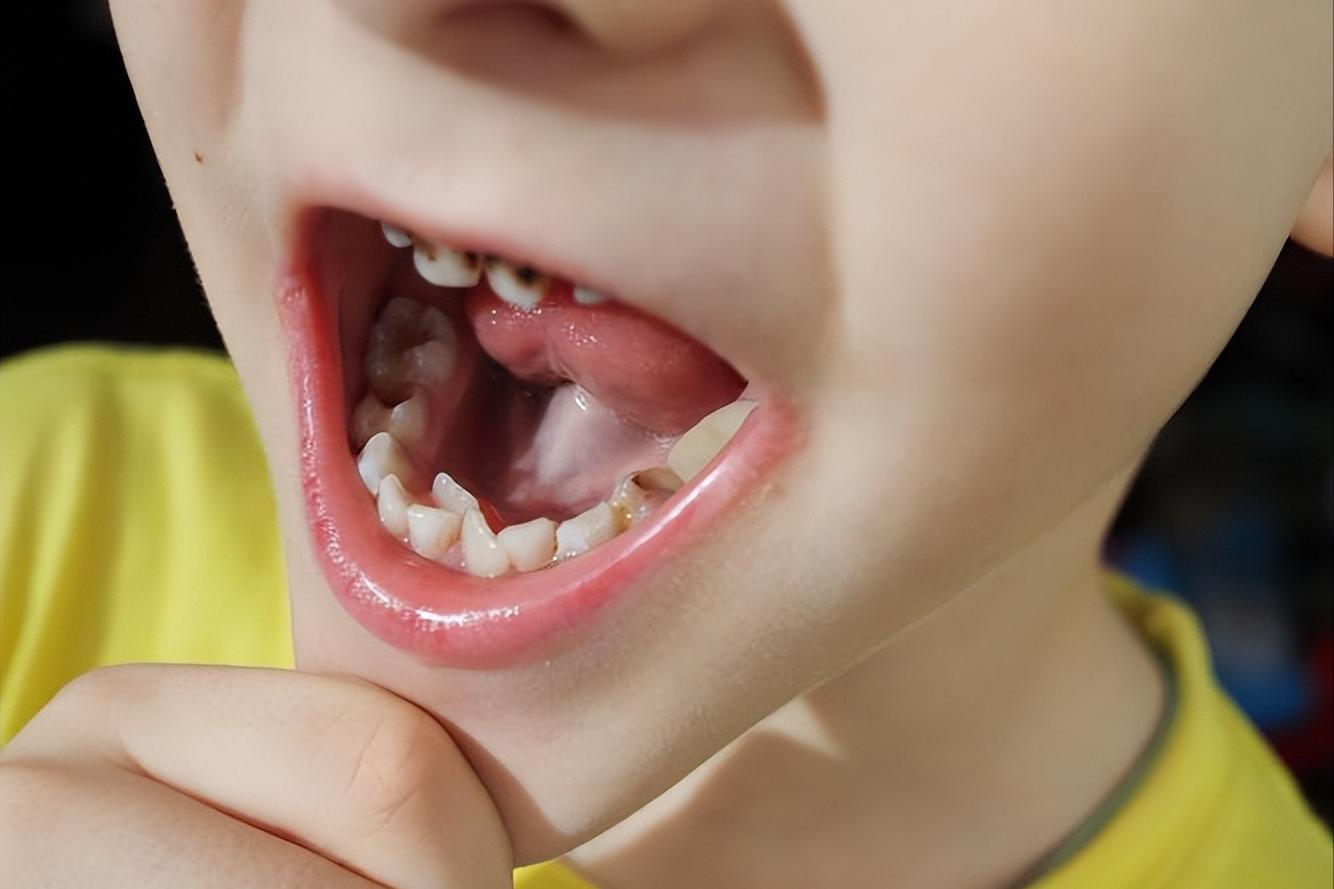 孩子有双排牙,小孩长双排牙前面的乳牙很松没掉