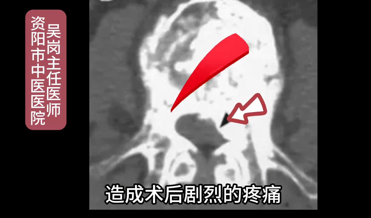 腰椎受伤造成压缩性骨折怎样治疗,腰椎骨折哪种情况适用于微创手术