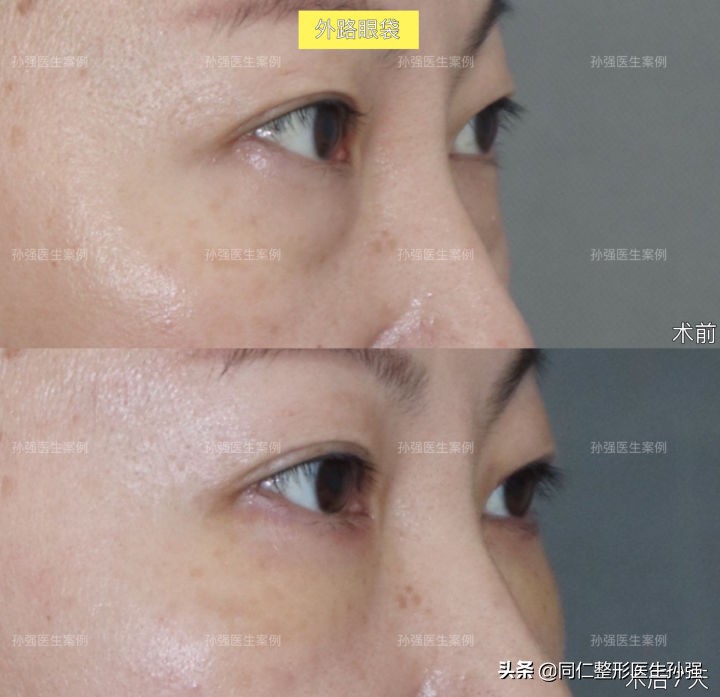 北京医院治眼袋,北京治疗眼袋好的方法