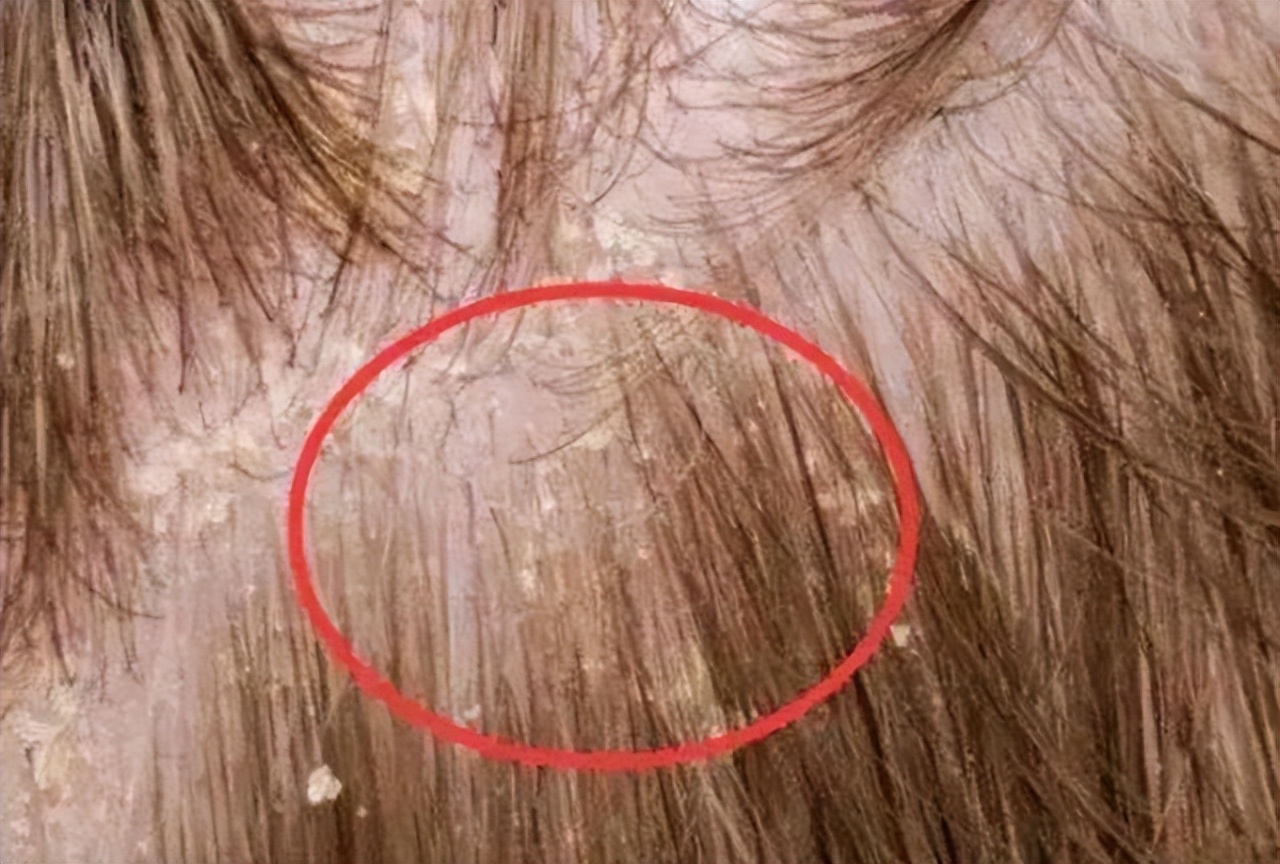 头皮上长红疙瘩和黄色脓包,头皮经常起小脓包疙瘩很疼