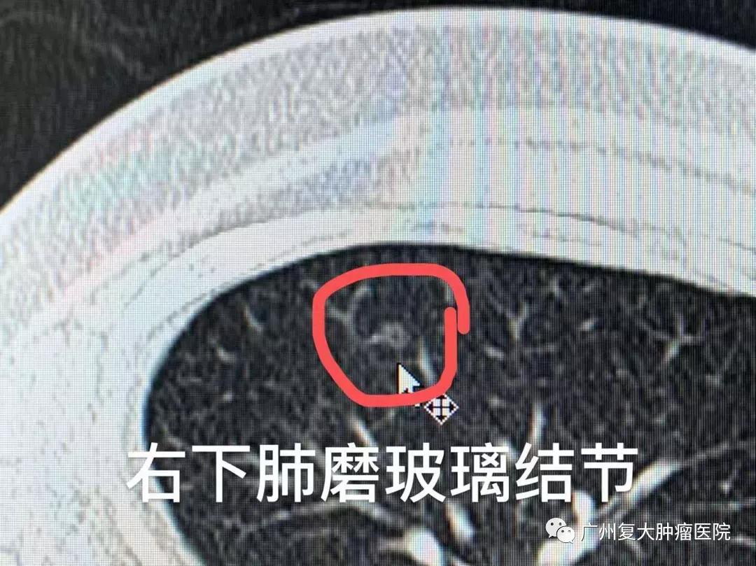 肺结节该观察还是手术？或许微创消融治疗是个不错的选择