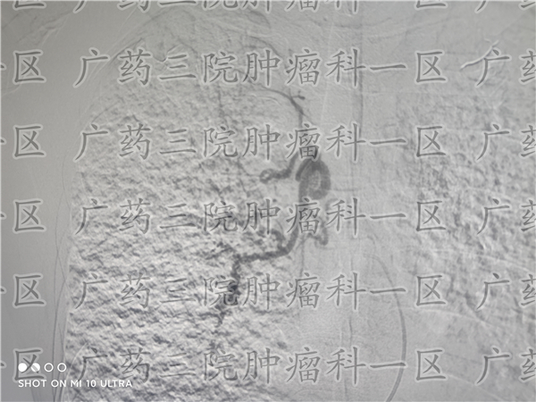 广州三甲医院宫颈癌筛查多少钱,广州哪家医院治疗宫颈癌最好的