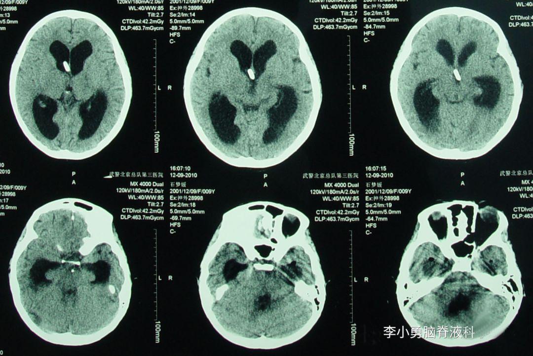儿童结核脑膜炎脑积水,结核性脑膜炎脑积水如何引起