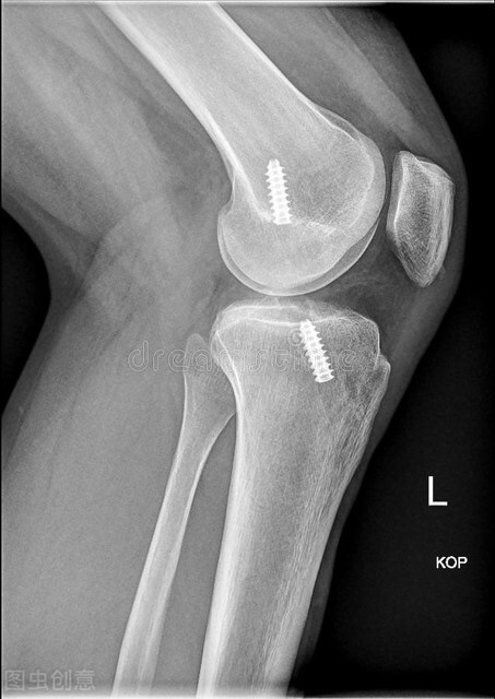 前交叉韧带损伤怎么治疗,前交叉韧带损伤疼痛部位