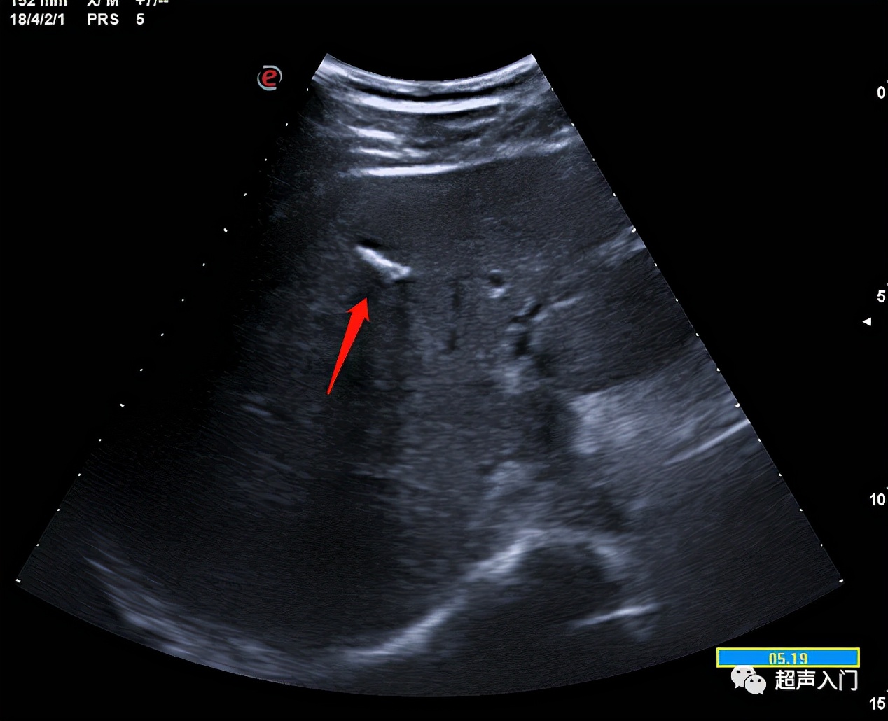 超声学自己能学吗,超声初学者有何窍门