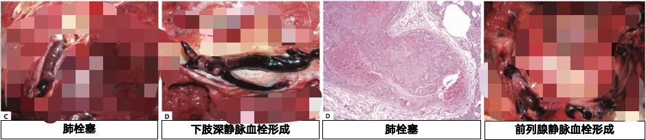 新冠后为什么要警惕无力感？发现单侧腿肿千万别揉十有八九会要命