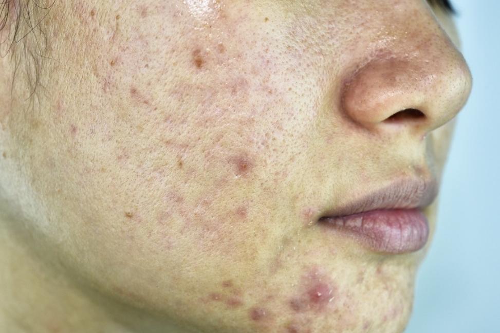 痘印和色斑什么东西最好遮,痘印色斑怎么最有效去除