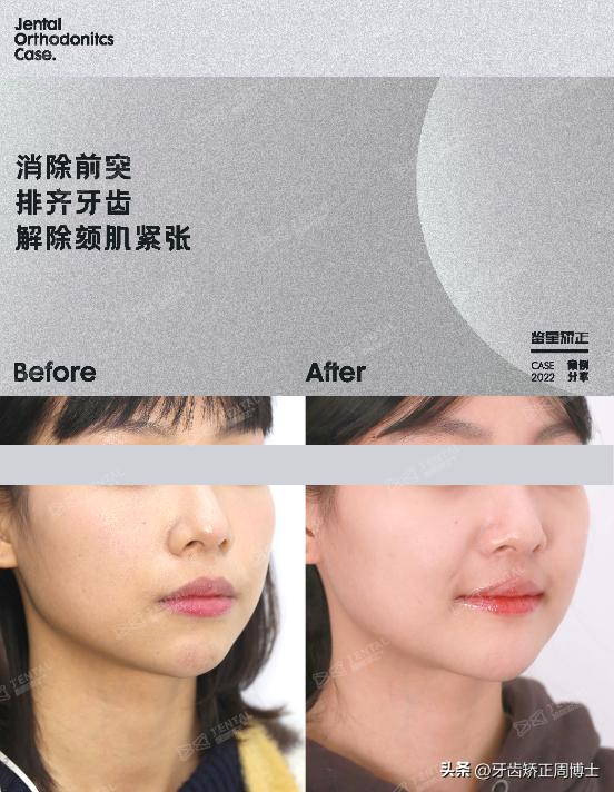 骨性龅牙矫正牙齿变小了,骨性龅牙已经做了正畸手术怎么办