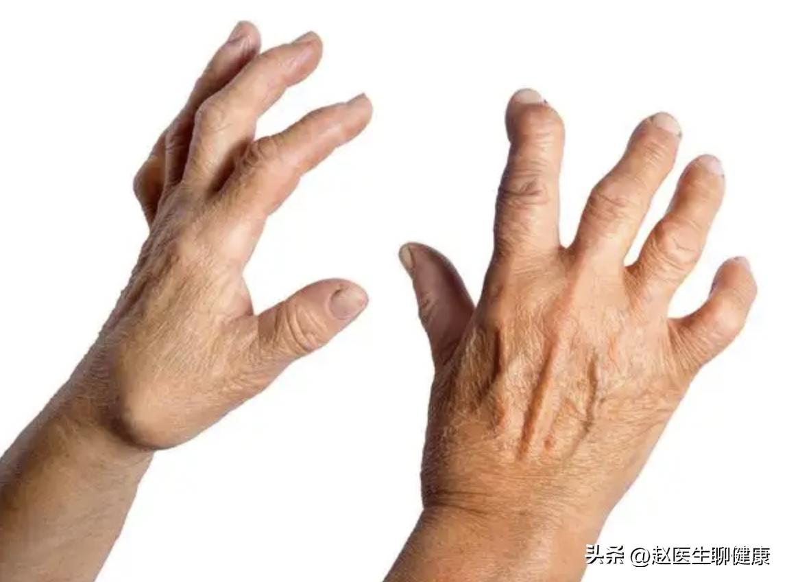 骨关节炎吃大活络丸还是小活络丸,大活络丸对膝关节痛有作用吗