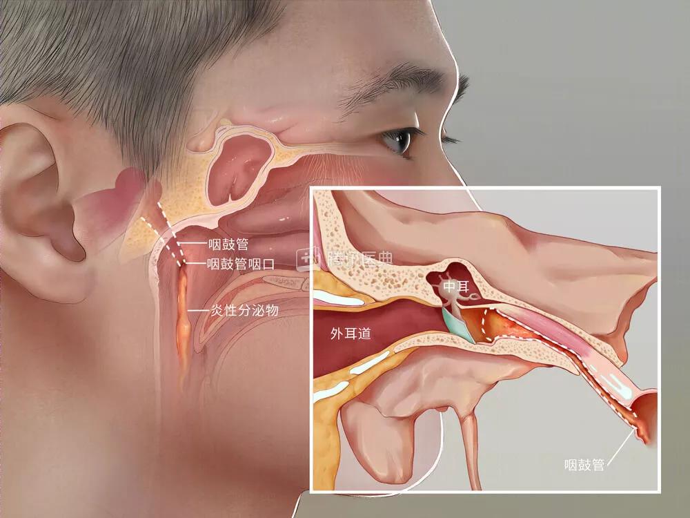 咽鼓管球囊扩张手术北京报销吗,鼓膜置管术和咽鼓管球囊扩张术