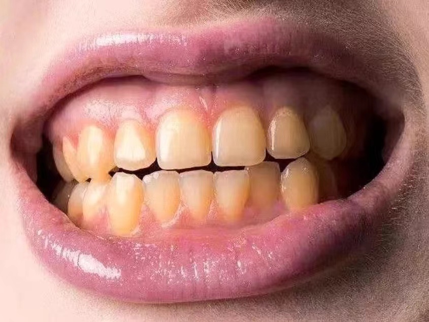满口黄牙怎么让牙齿变白,长期牙黄牙齿变白的快速小妙招
