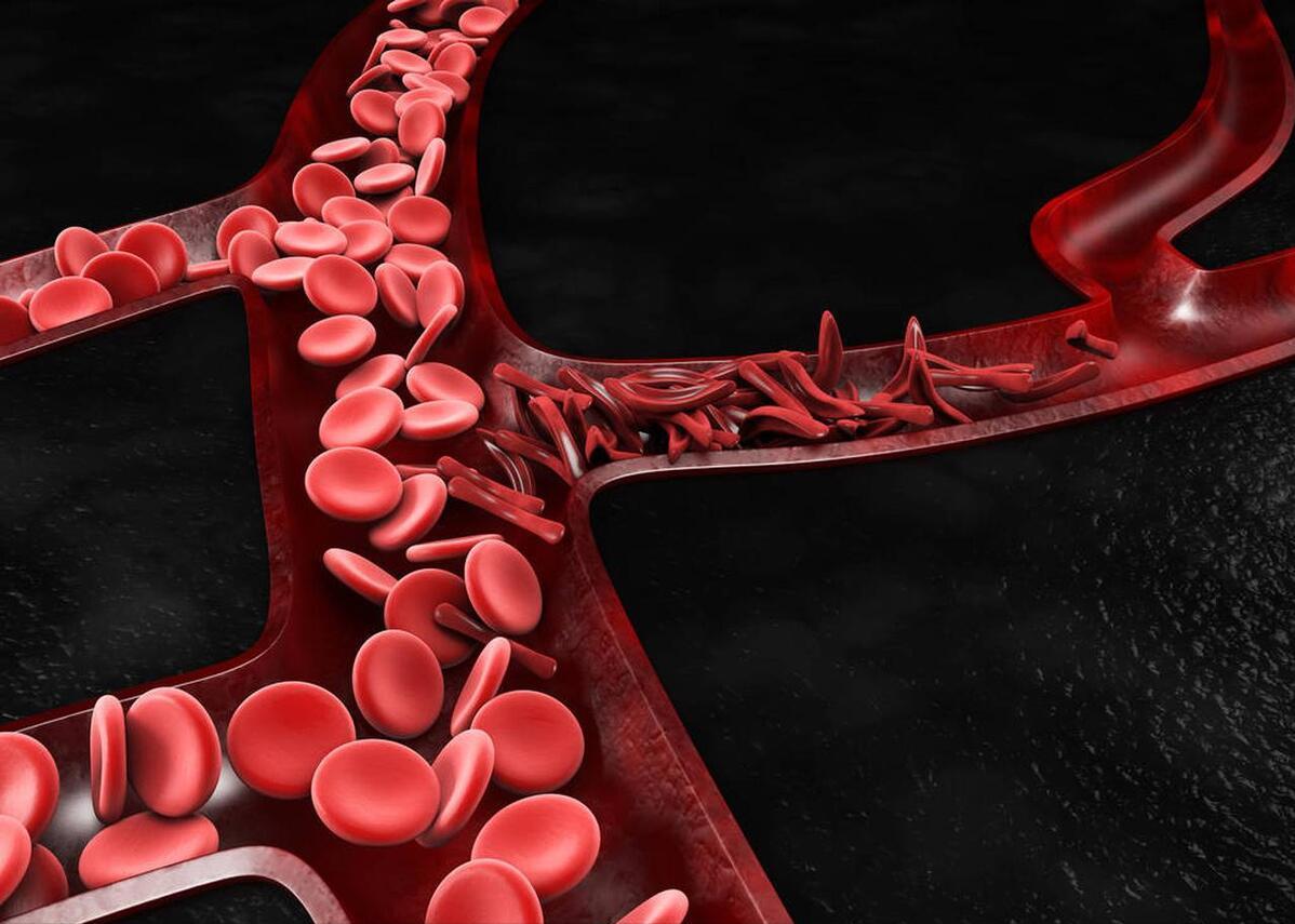 结直肠癌一般发病年龄,结直肠癌的诱因及病因