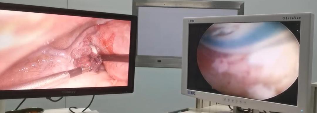 医生，B超提示我有子宫畸形，怎么办？