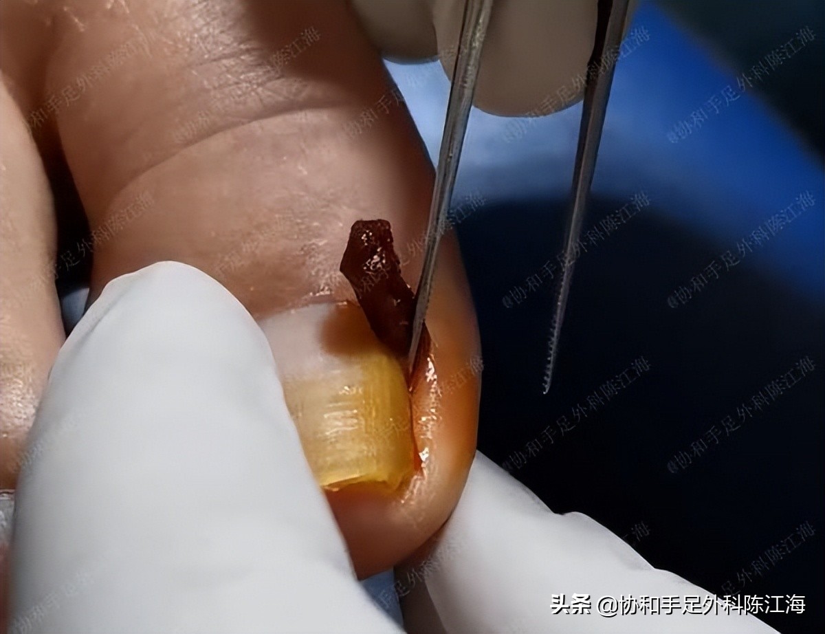 嵌甲炎拔甲还能长出来嘛,指甲根部嵌甲太深拔不出来怎么办