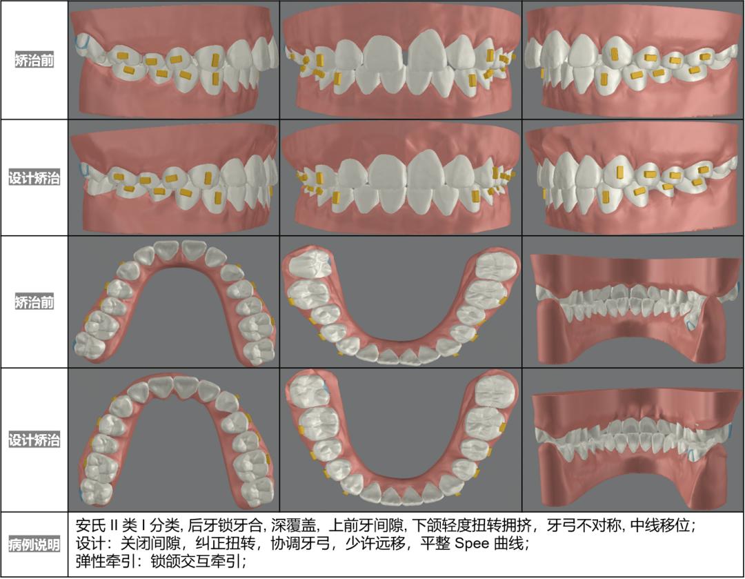 无托槽隐形矫治流程,隐形矫正早期干预