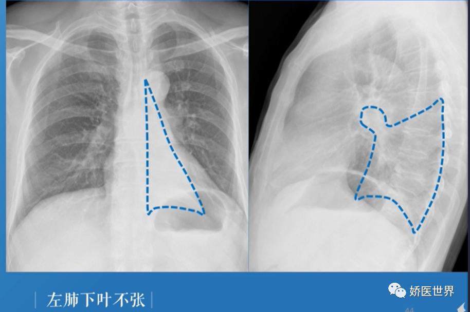 慢性阻塞性肺病肺不张,阻塞性肺不张会出现的临床症状
