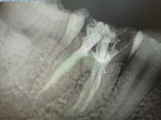牙疼的厉害怎么办最快止疼牙髓炎,牙疼如果是牙髓炎怎样治