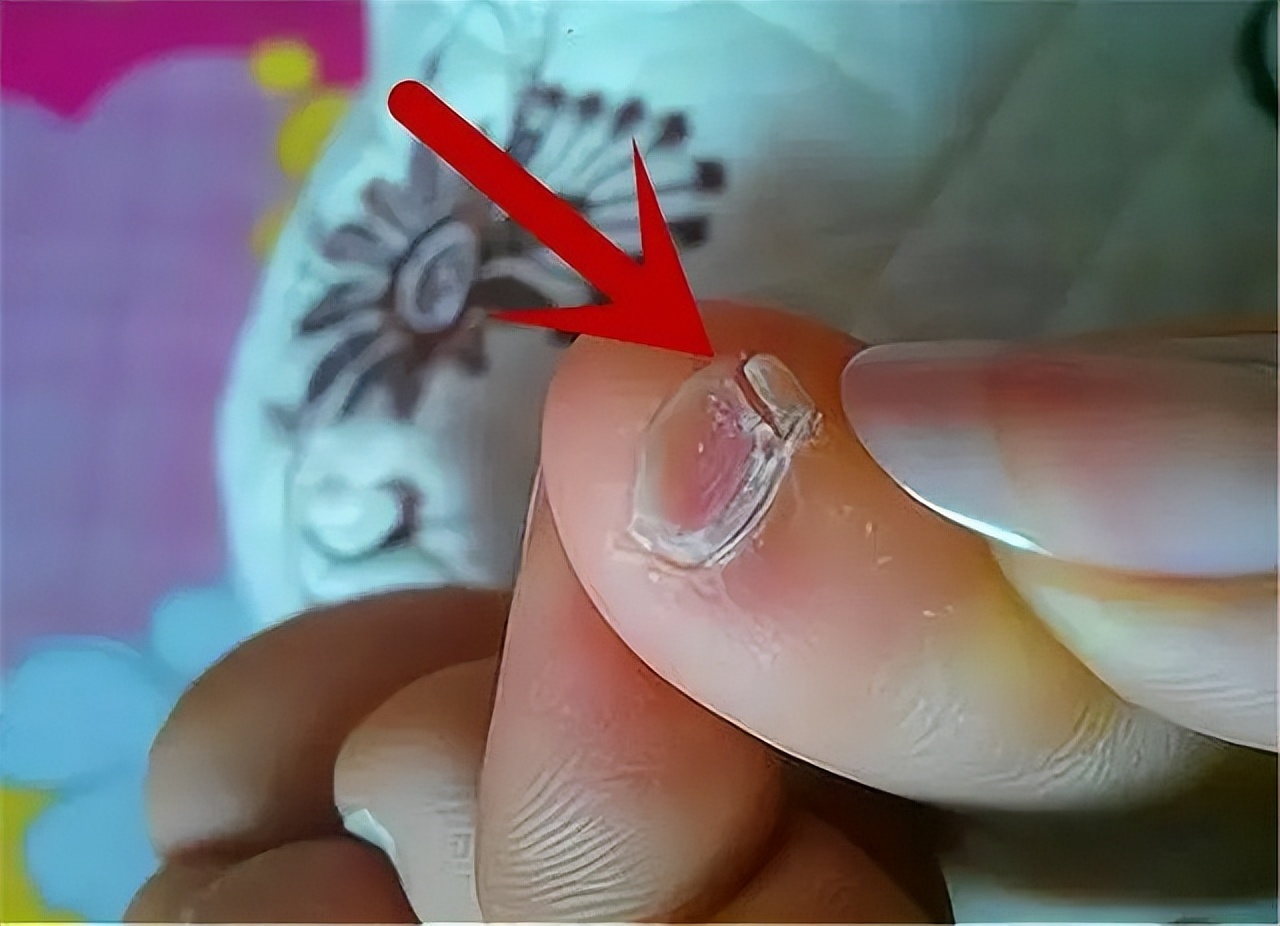 汉族小脚趾甲是两瓣的,汉族小脚趾甲是两瓣图片