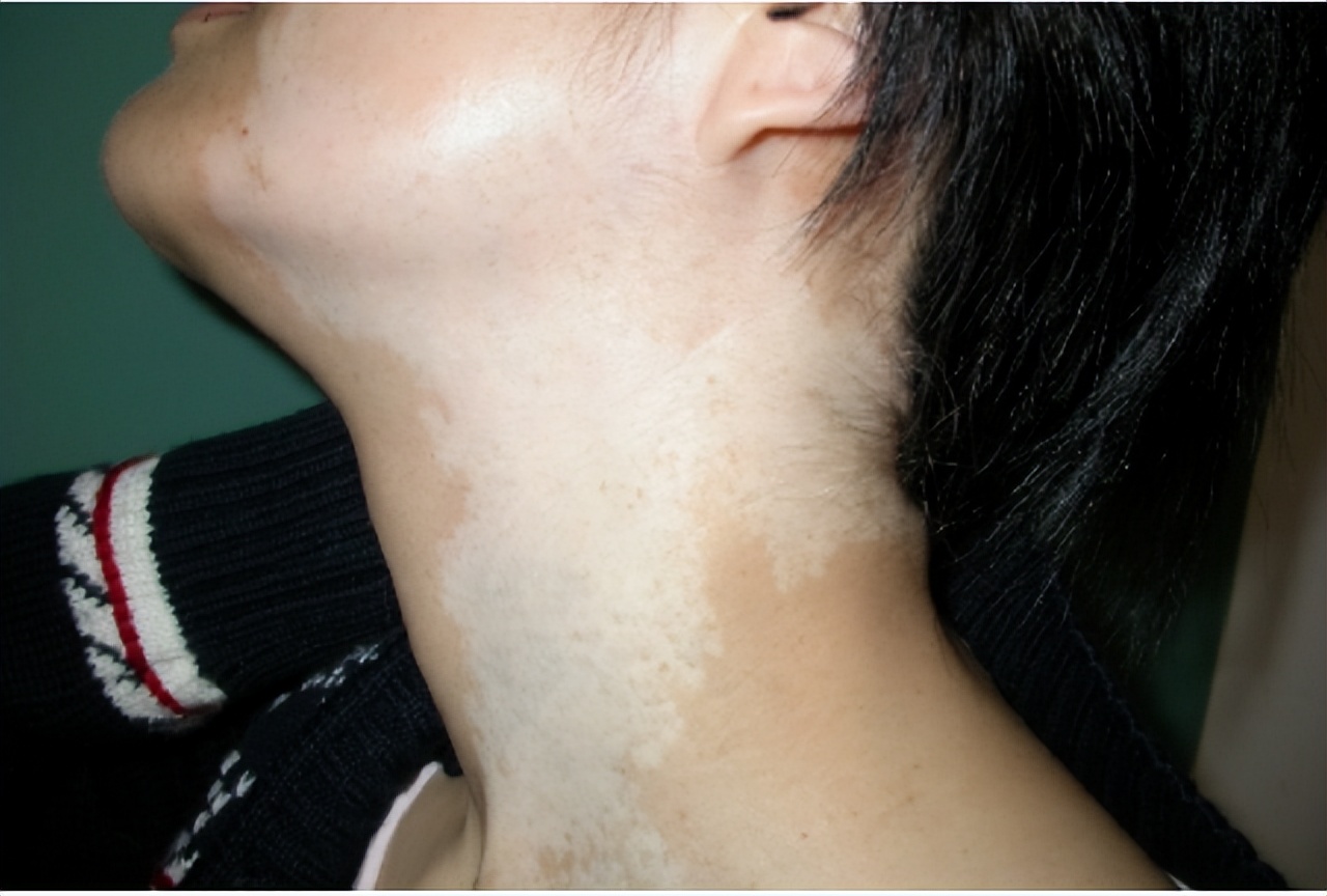 皮肤色素减退和白癜风有什么区别,白癜风是不是色素性皮肤病