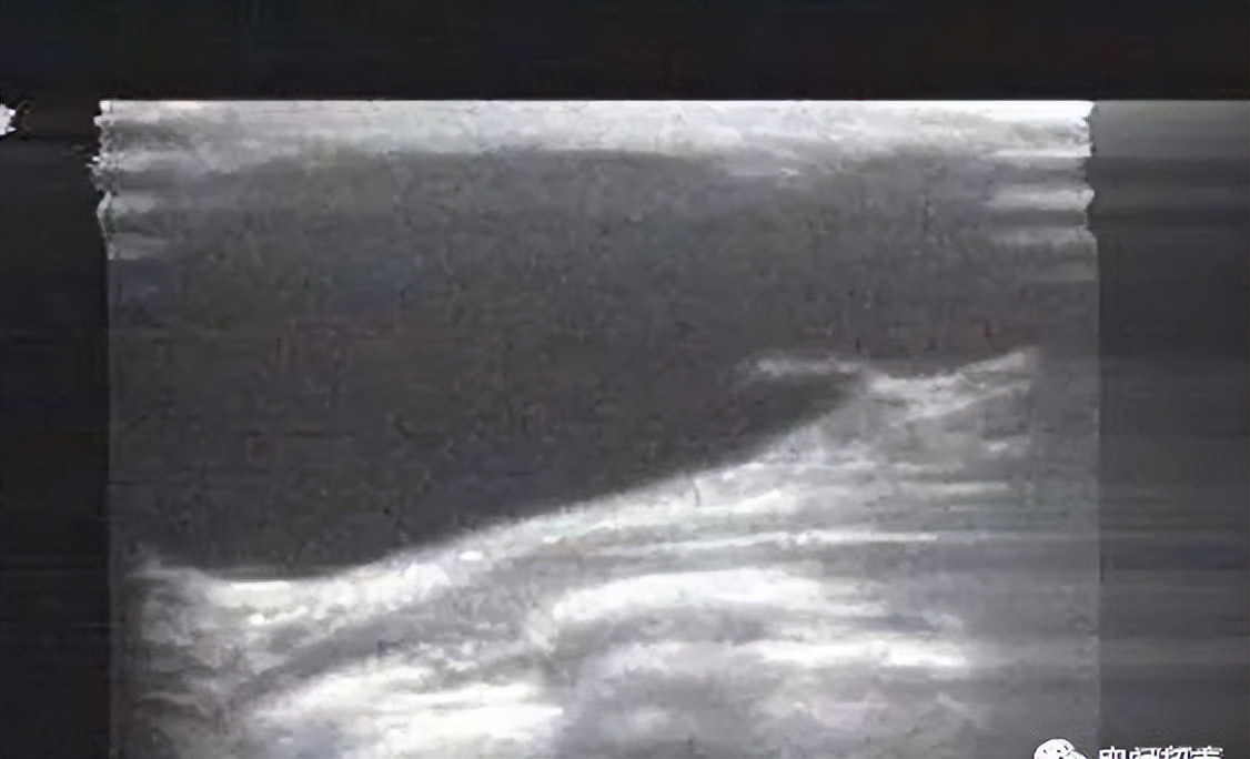 腋窝包块超声鉴别诊断,腋窝淋巴结检查法