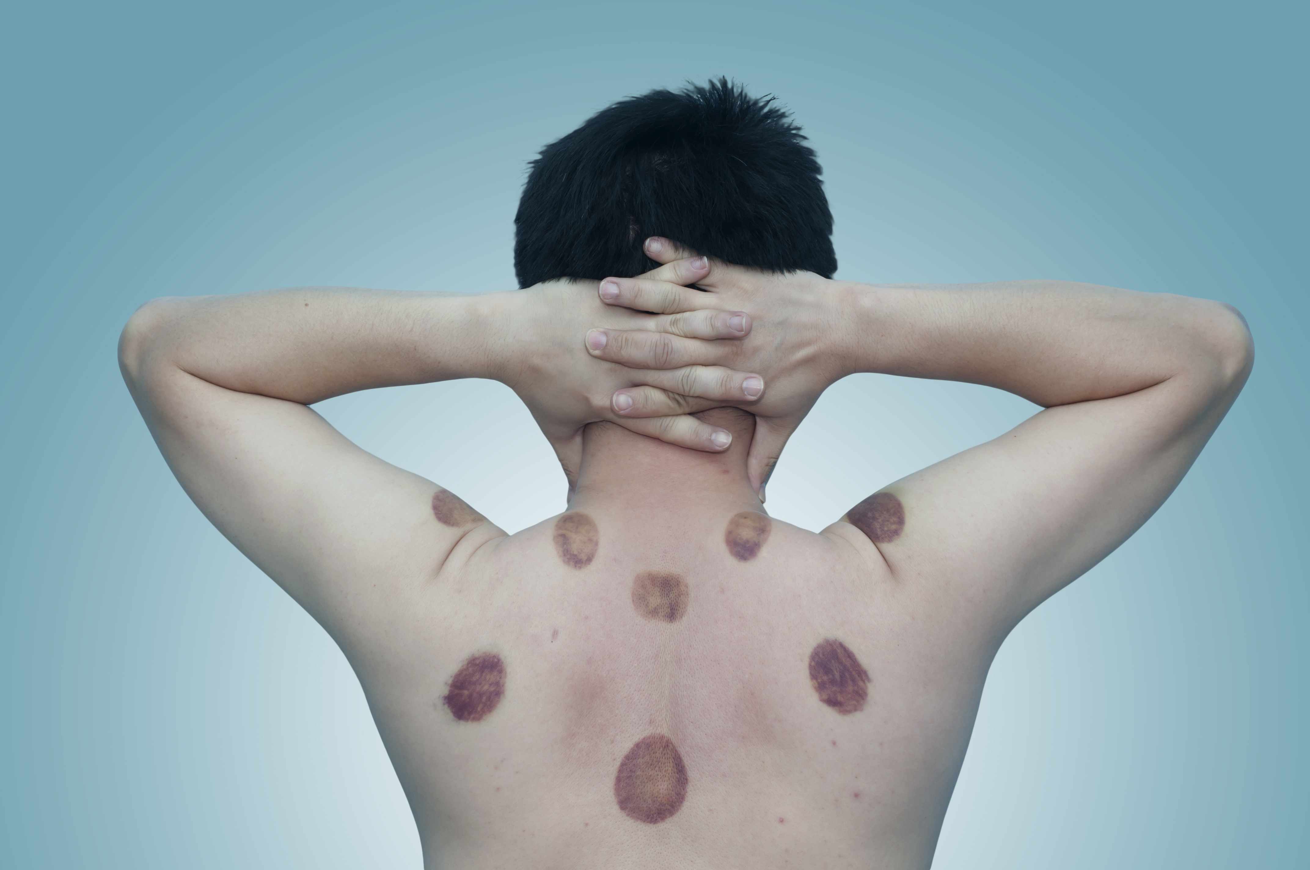 湿热体质的食疗方法是什么,湿热如何中药调理最好呢