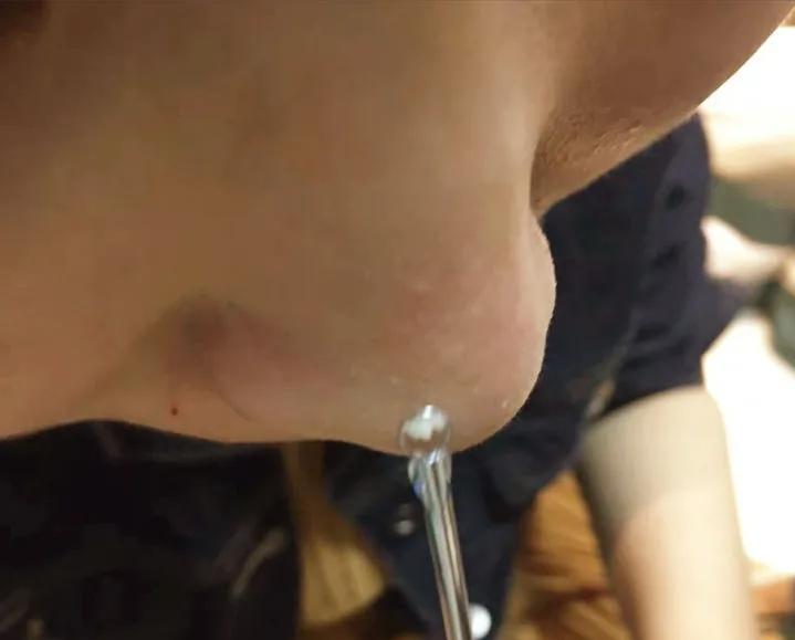 鼻子黑头感觉脏脏的,草莓黑头怎么去除最有效