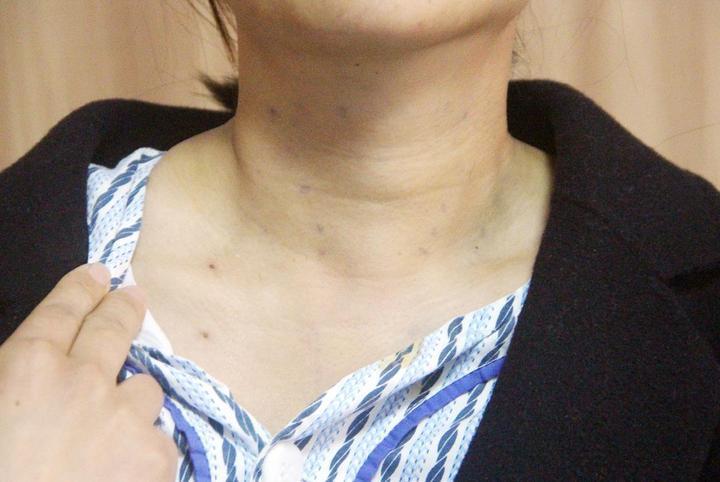 甲状腺结节能吃白菜和卷心菜吗,甲状腺结节的人能吃白菜吗