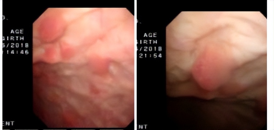 手术切除加卡介苗膀胱灌注，退休大叔的膀胱癌不再复发