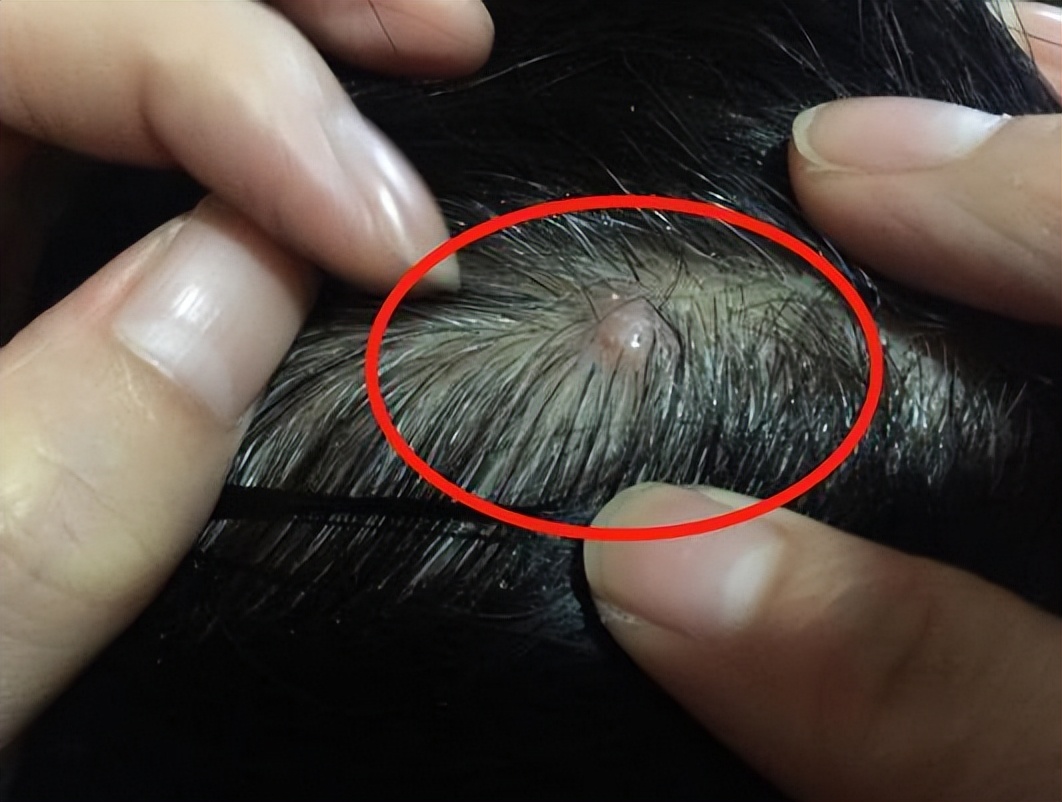 头皮后脑勺长红疙瘩有脓包,为什么头皮上总是长脓包和痘痘
