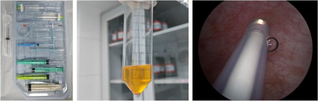 prp治疗间质性膀胱炎,间质性膀胱炎prp治疗价位